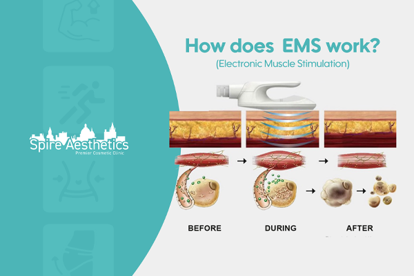 EMS treatment for post pregnancy weight loss treatment Newcastle
