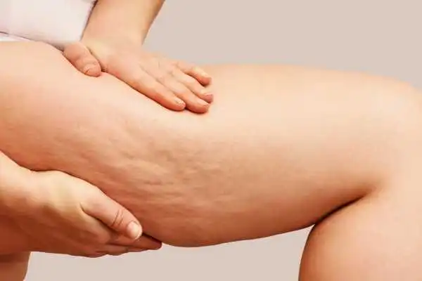 Image of woman showing leg with cellulite Newcastle