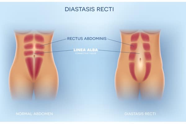 What Non-Surgical Options Are Available for Diastasis Recti Newcastle?
