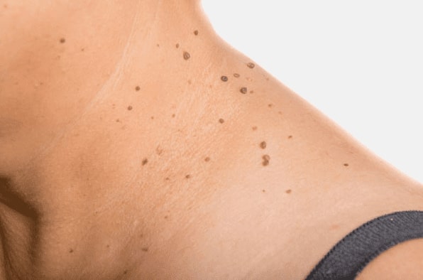 Are you looking for easy skin tag removal Newcastle - then contact Spire today!