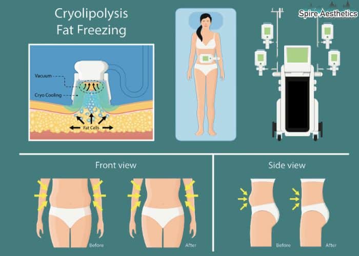 Image of diet and fat freezing combined for best results for Spire Aesthetics Newcastle