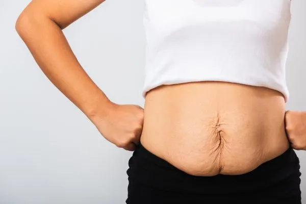 Image of a woman's stomach after weight loss with sagging skin following a gastric band Newcastle