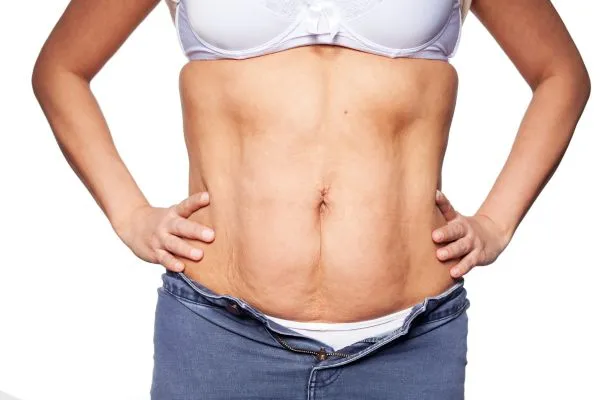 sagging skin on woman's stomach after weight loss injections Newcastle