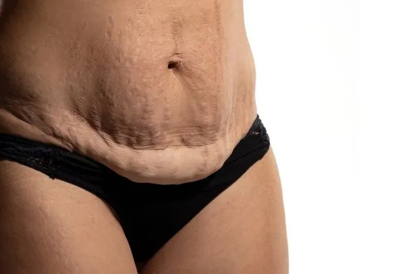 Image of womans stomach after weight loss injections Newcastle showing saggy skin
